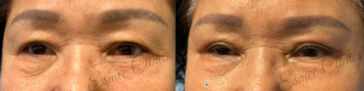 Before and After img